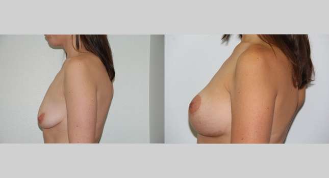 Breast Lift: Image #408