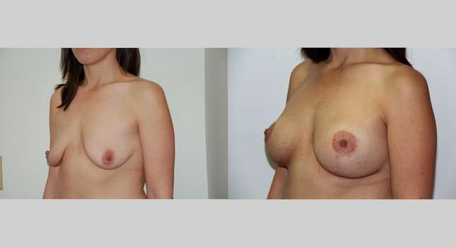 Breast Lift: Image #409