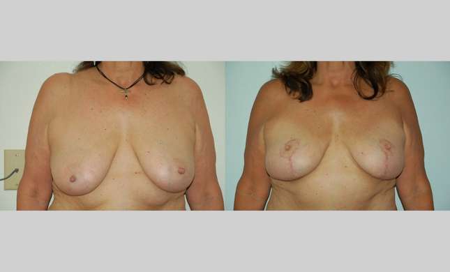 Breast Lift: Image #454