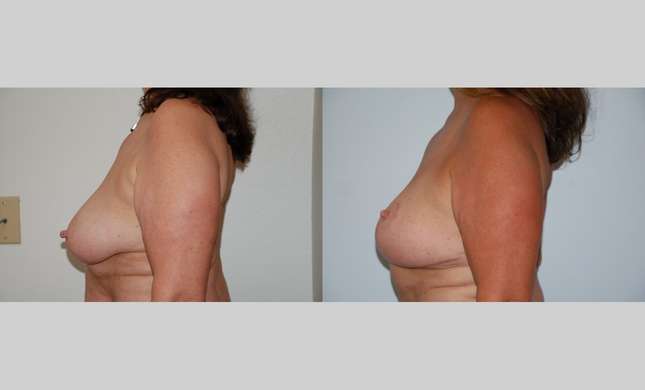 Breast Lift: Image #455