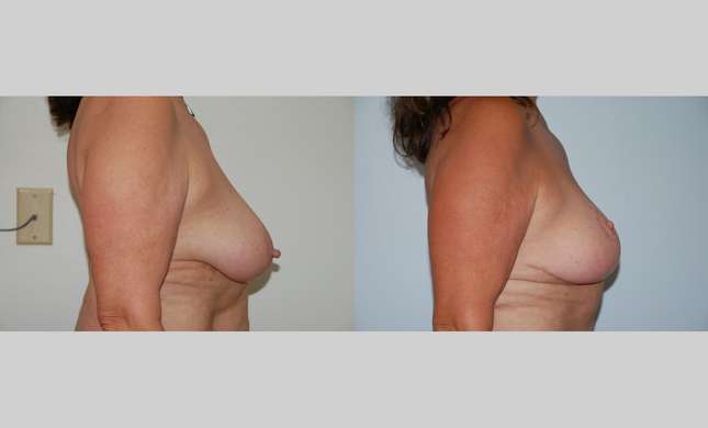 Breast Lift: Image #456