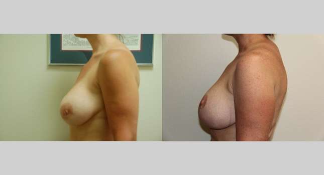 Breast Lift: Image #569