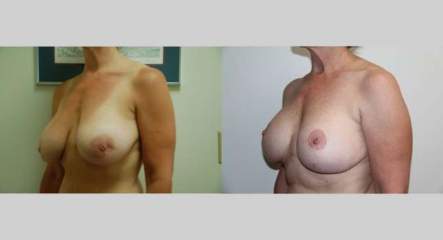 Breast Lift: Image #570