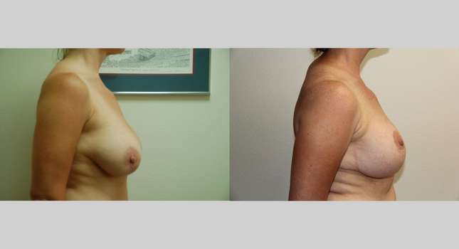 Breast Lift: Image #571