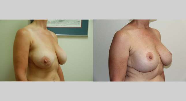 Breast Lift: Image #572