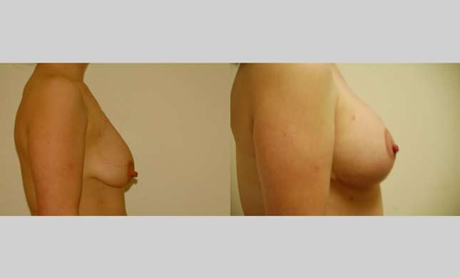 Breast Lift: Image #72