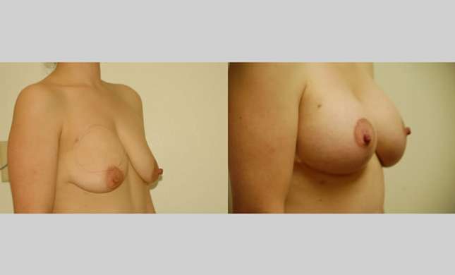 Breast Lift: Image #73