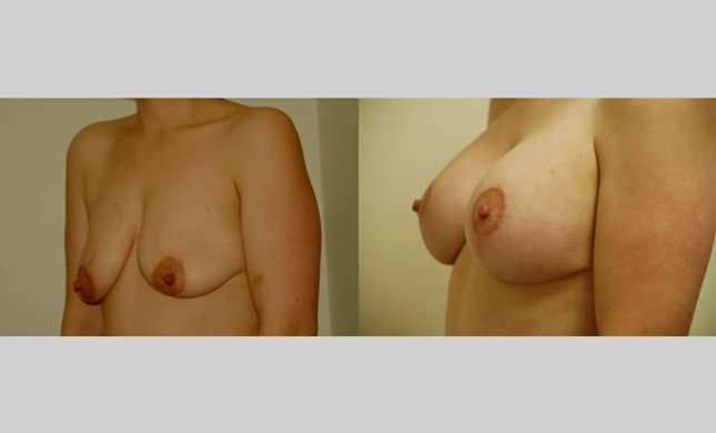 Breast Lift: Image #74