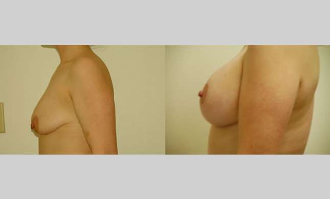 Breast Lift: Image #75