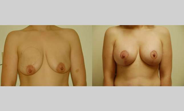 Breast Lift: Image #76