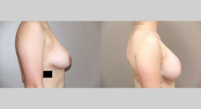 Breast Lift: Image #764