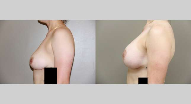 Breast Lift: Image #765