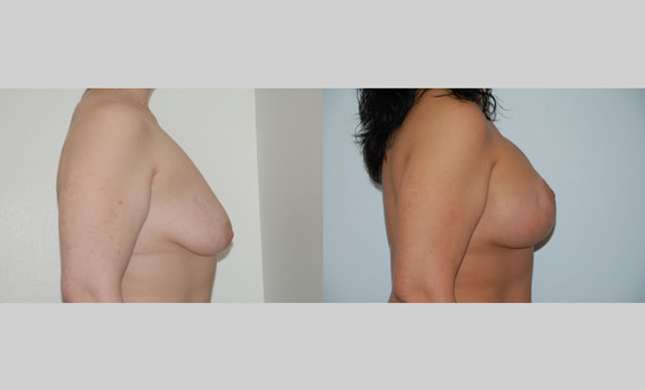 Breast Lift: Image #77