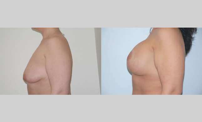Breast Lift: Image #78
