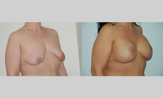 Breast Lift: Image #79