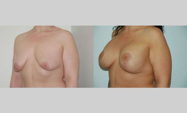 Breast Lift: Image #80
