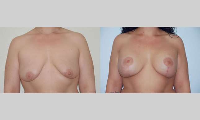 Breast Lift: Image #81