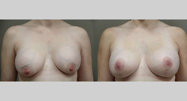 Breast Lift: Image #810