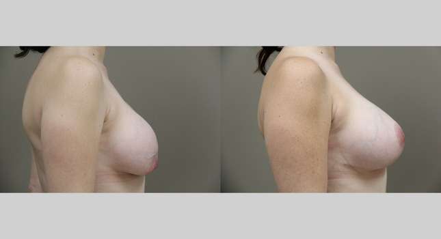 Breast Lift: Image #811