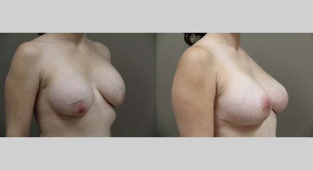 Breast Lift: Image #812