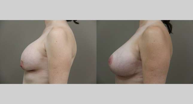 Breast Lift: Image #813
