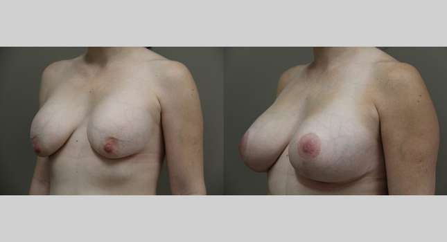 Breast Lift: Image #814