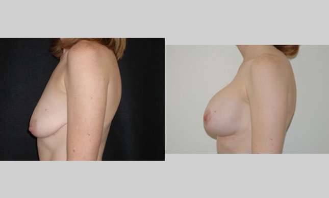 Breast Lift: Image #82