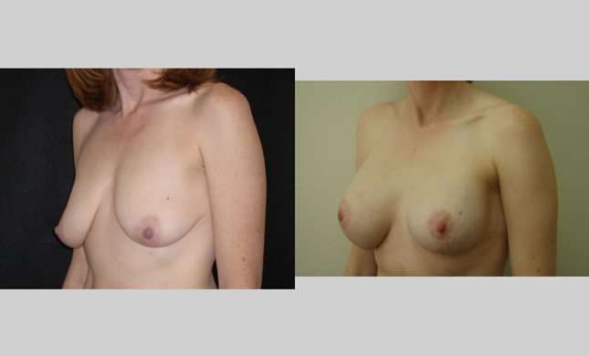 Breast Lift: Image #83