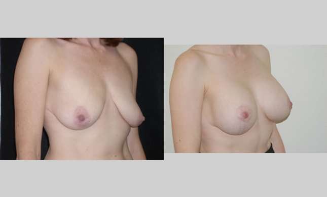Breast Lift: Image #84