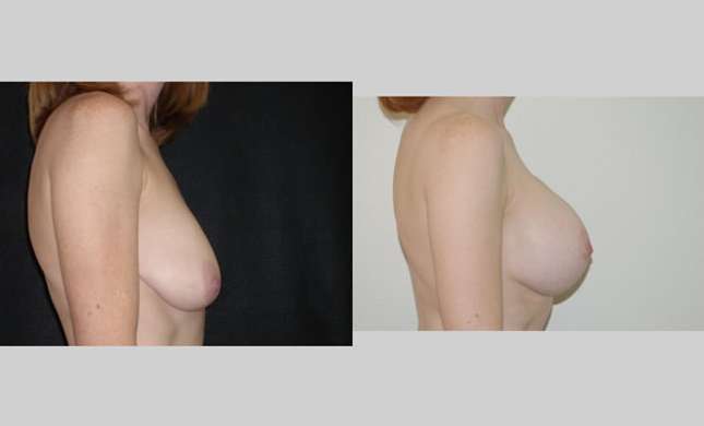 Breast Lift: Image #85