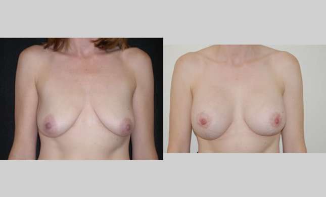 Breast Lift: Image #86