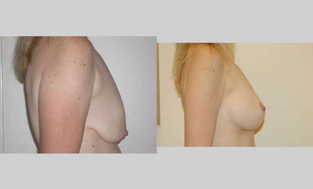 Breast Lift: Image #87