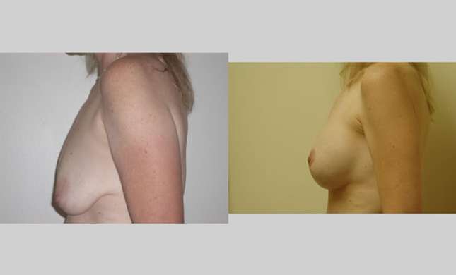 Breast Lift: Image #88