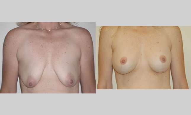 Breast Lift: Image #89