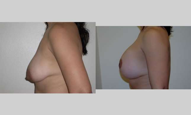 Breast Lift: Image #90