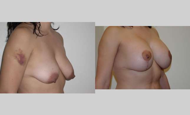 Breast Lift: Image #91