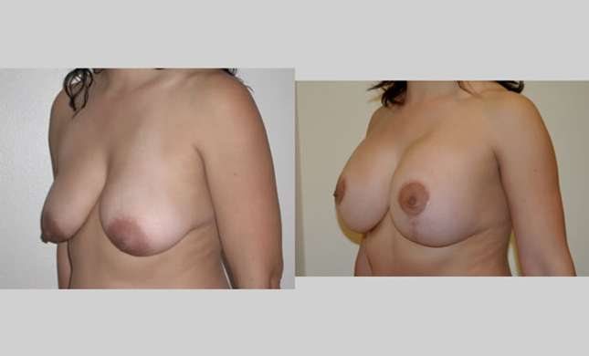 Breast Lift: Image #92