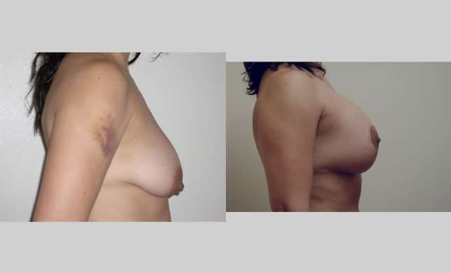 Breast Lift: Image #93