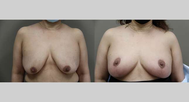 Breast Lift: Image #934