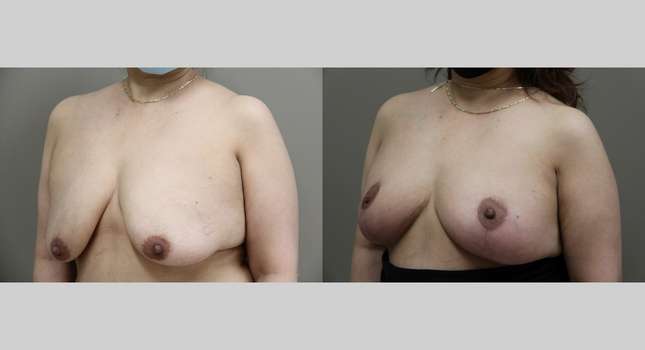 Breast Lift: Image #935