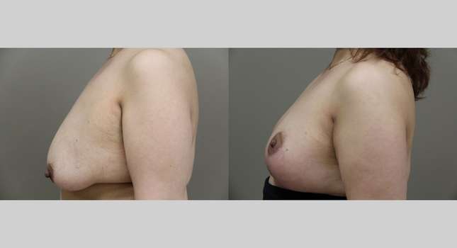 Breast Lift: Image #936