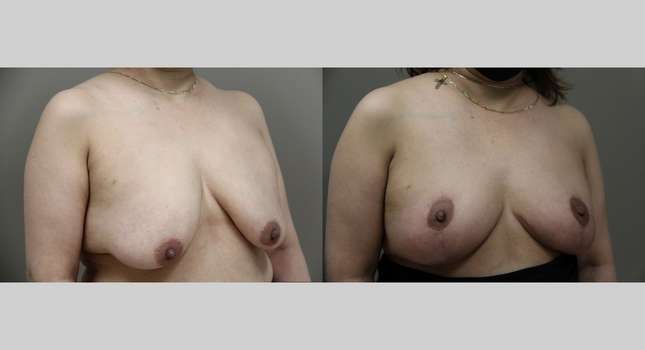 Breast Lift: Image #937