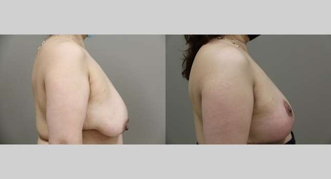 Breast Lift: Image #938