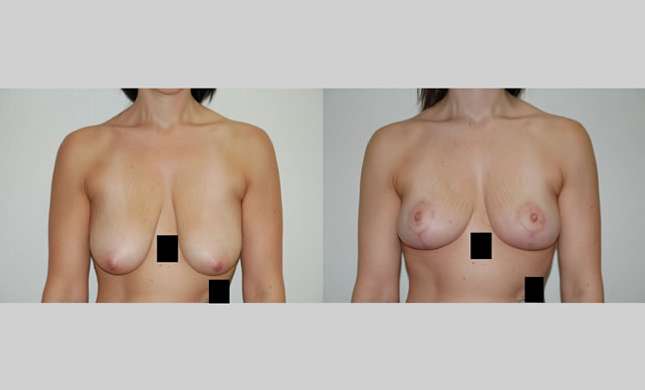 Breast Lift: Image #94