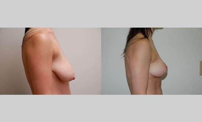 Breast Lift: Image #95