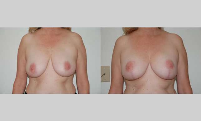 Breast Lift: Image #97