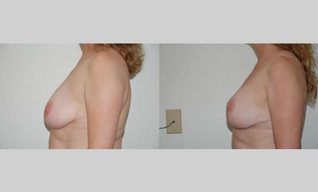 Breast Lift: Image #98