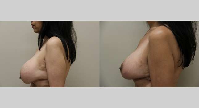Breast Lift: Image #994