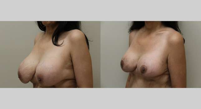 Breast Lift: Image #995
