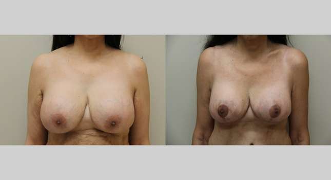 Breast Lift: Image #996
